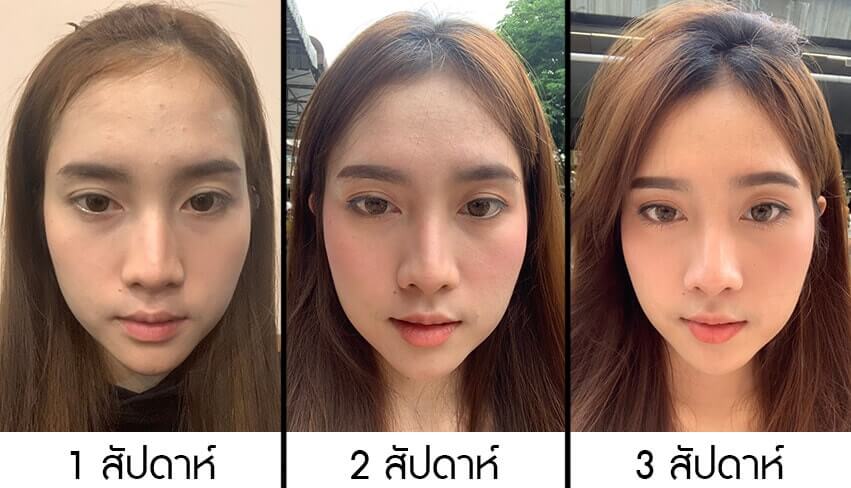 รีวิวเมโสแก้มย้อย