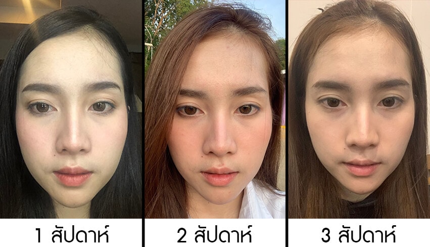 รีวิวเมโสแฟต