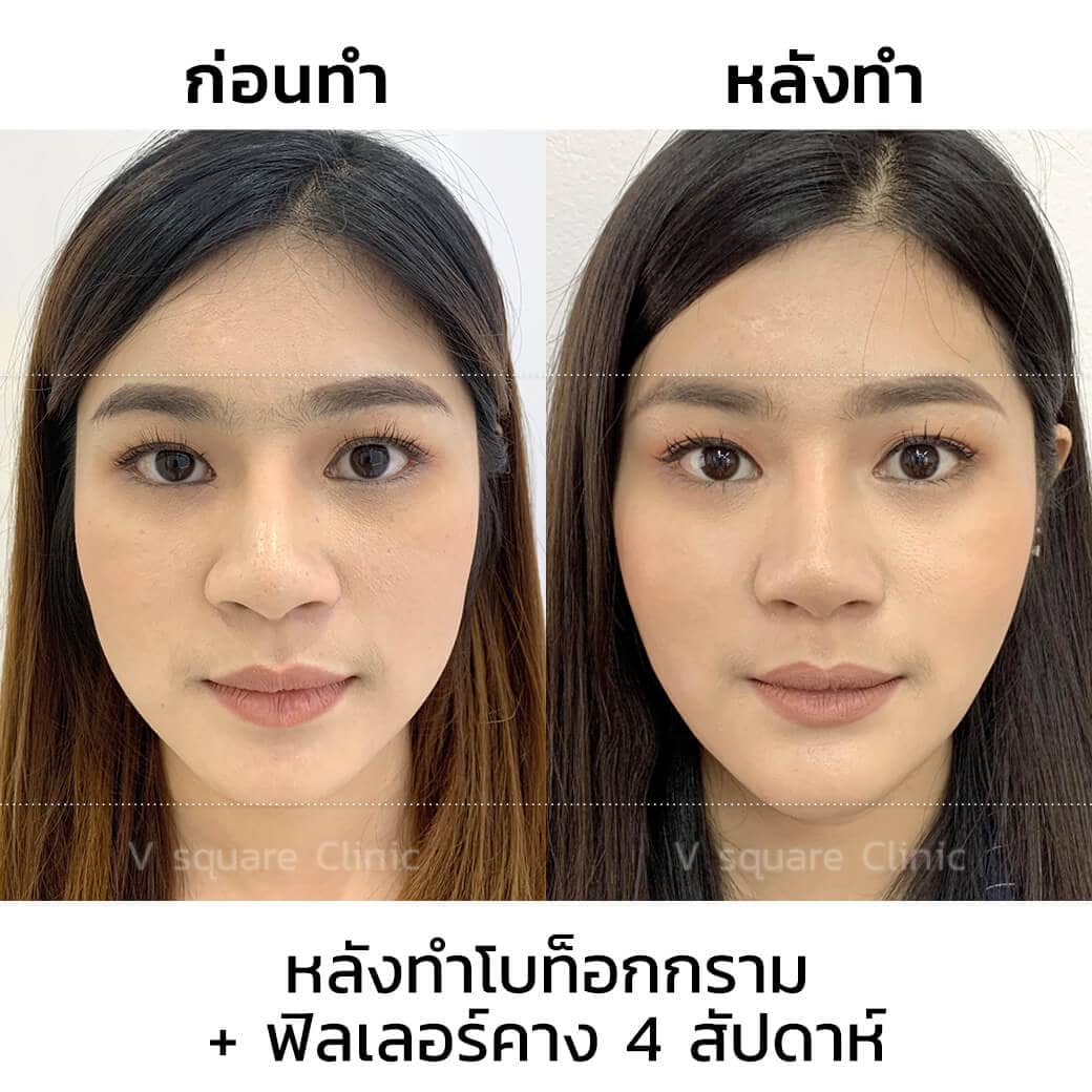 โบท็อกลดกรามและฟิลเลอร์คาง หลังทำ