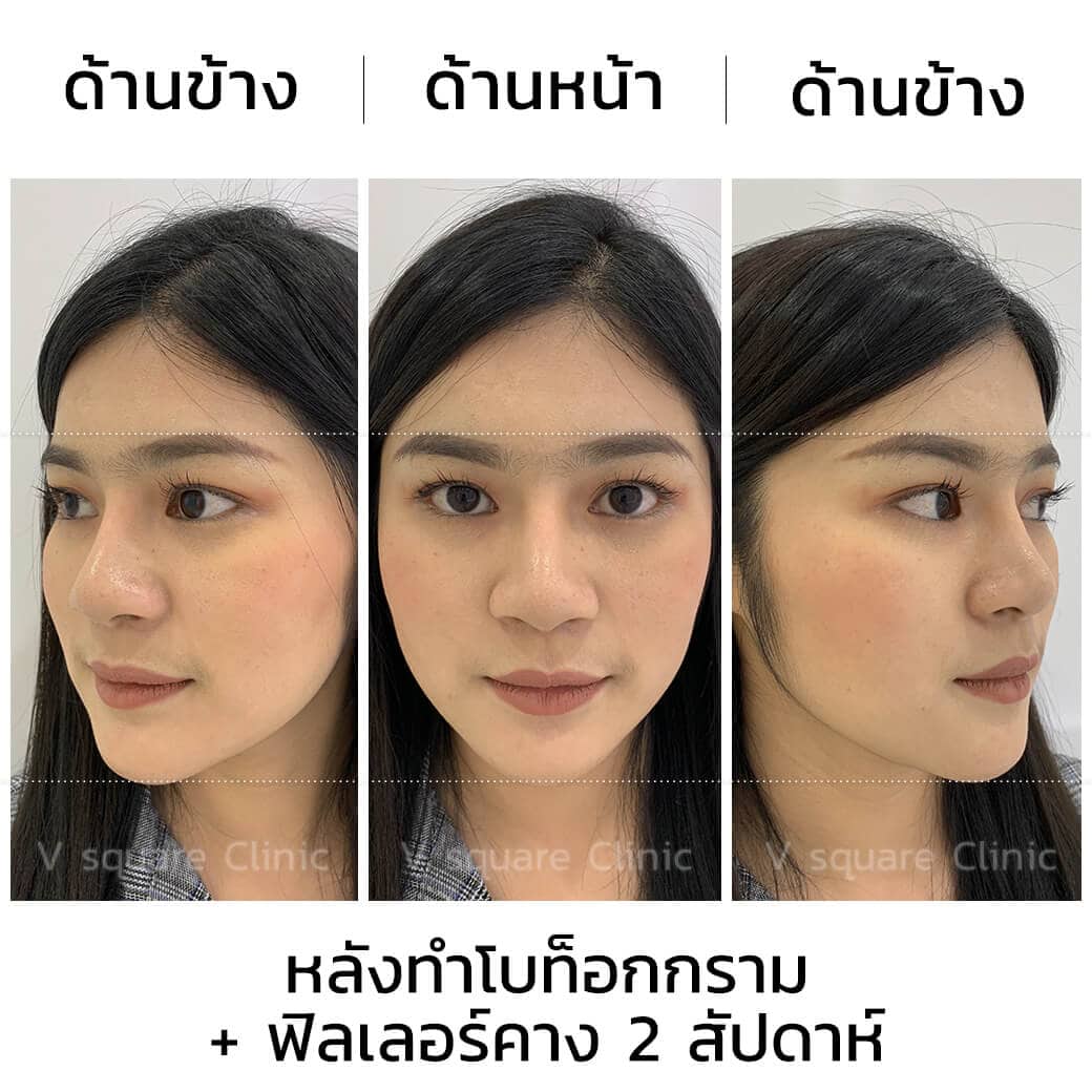 โบท็อกลดกรามและฟิลเลอร์คาง หลังทำ