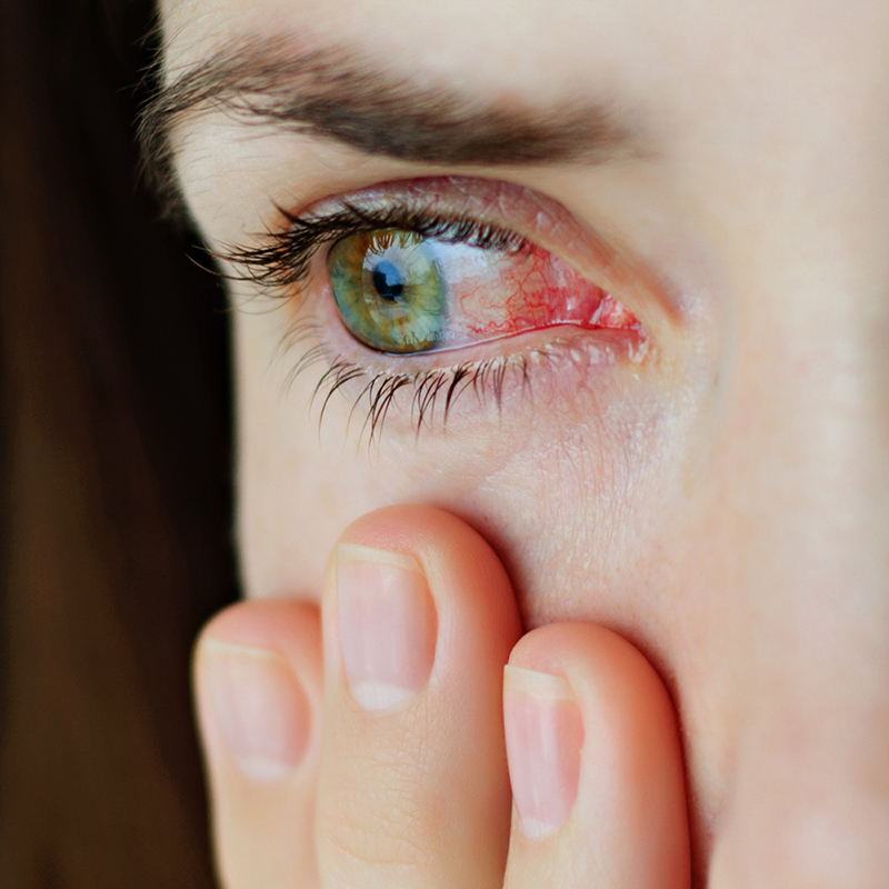 hyaluronic-acid-บรรเทาอาการตาแห้ง
