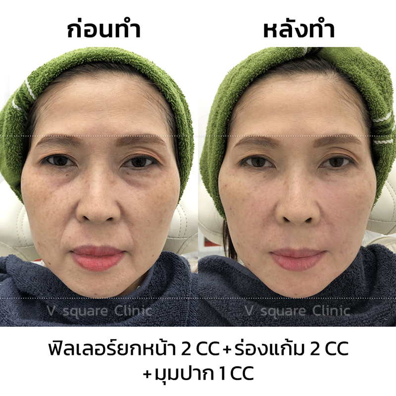 รีวิว-ฟิลเลอร์ยกหน้า-ร่องแก้ม-มุมปาก-ด้วยไฮยาลูรอน