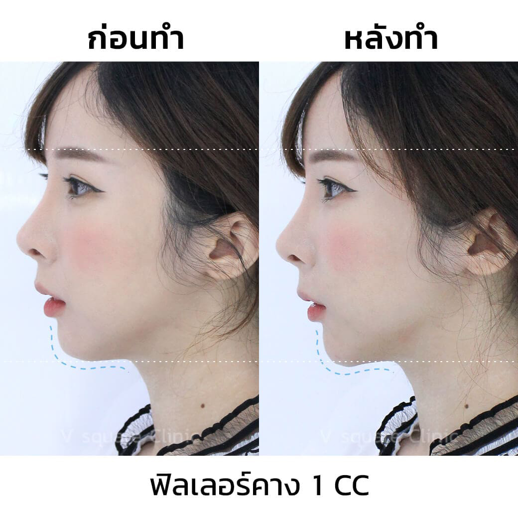 รีวิวฟิลเลอร์คาง-1-CC