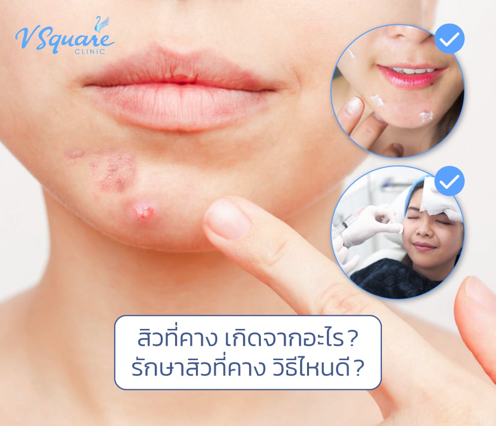 สิวที่คาง