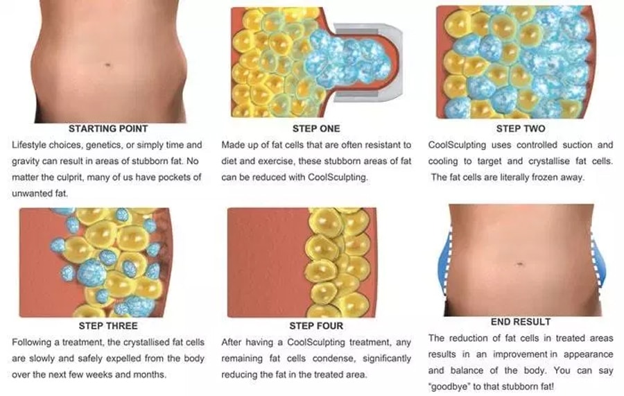 Coolsculpting นิยมทำส่วนไหน