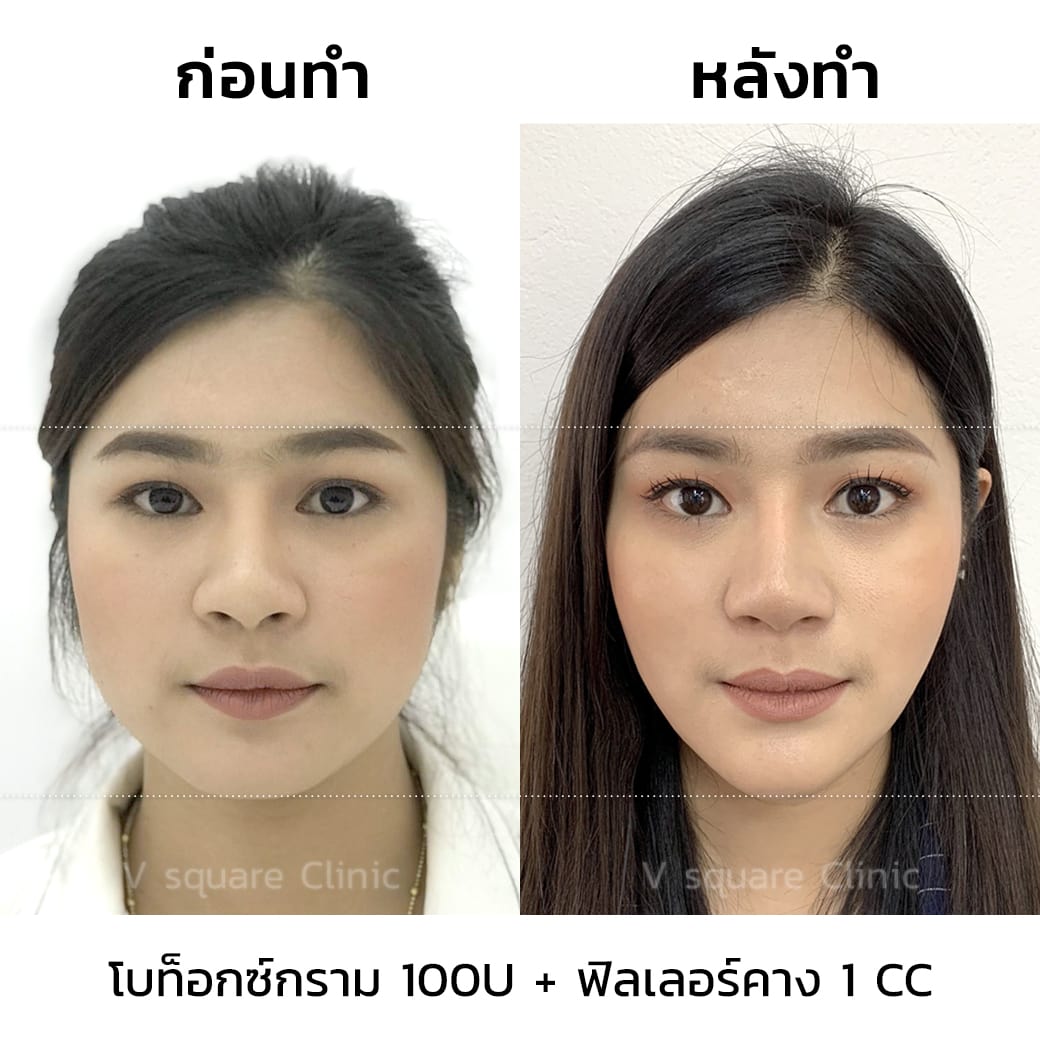 ฉีดโบท็อก ราคา