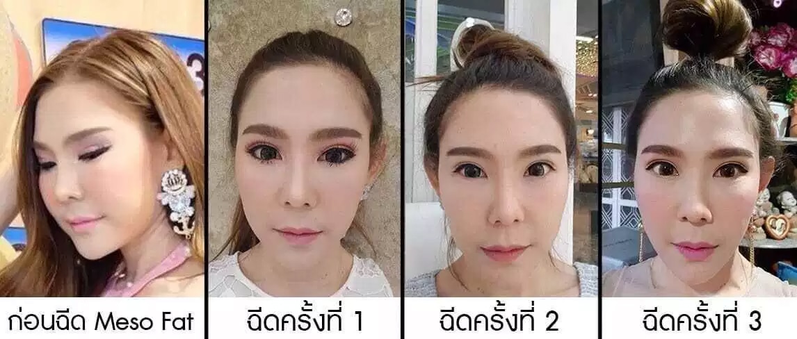 รีวิวก่อนฉีดเมโสแฟต