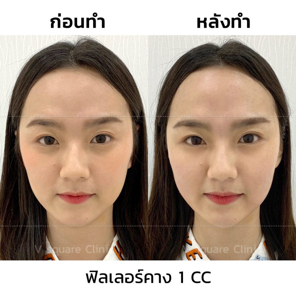 รีวิวฟิลเลอร์คาง1CC