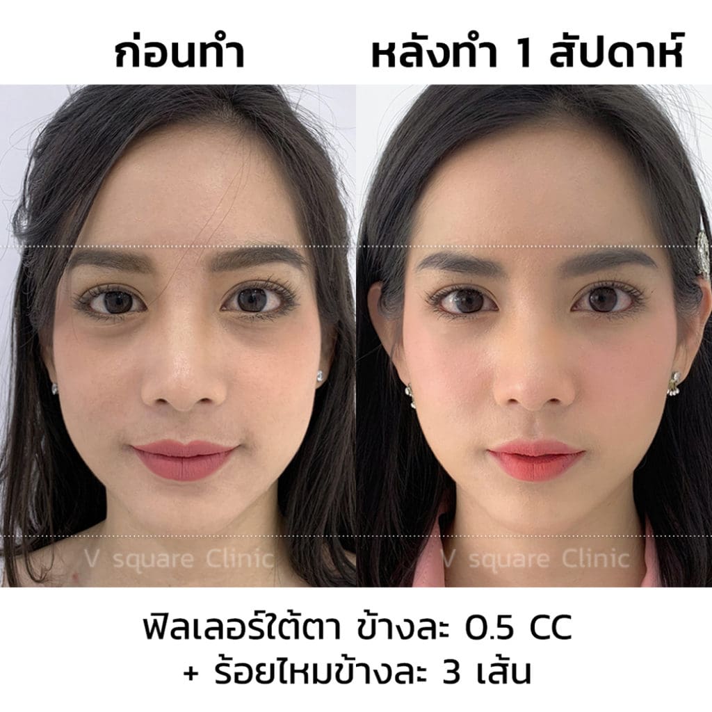 รีวิวฟิลเลอร์ใต้ตา