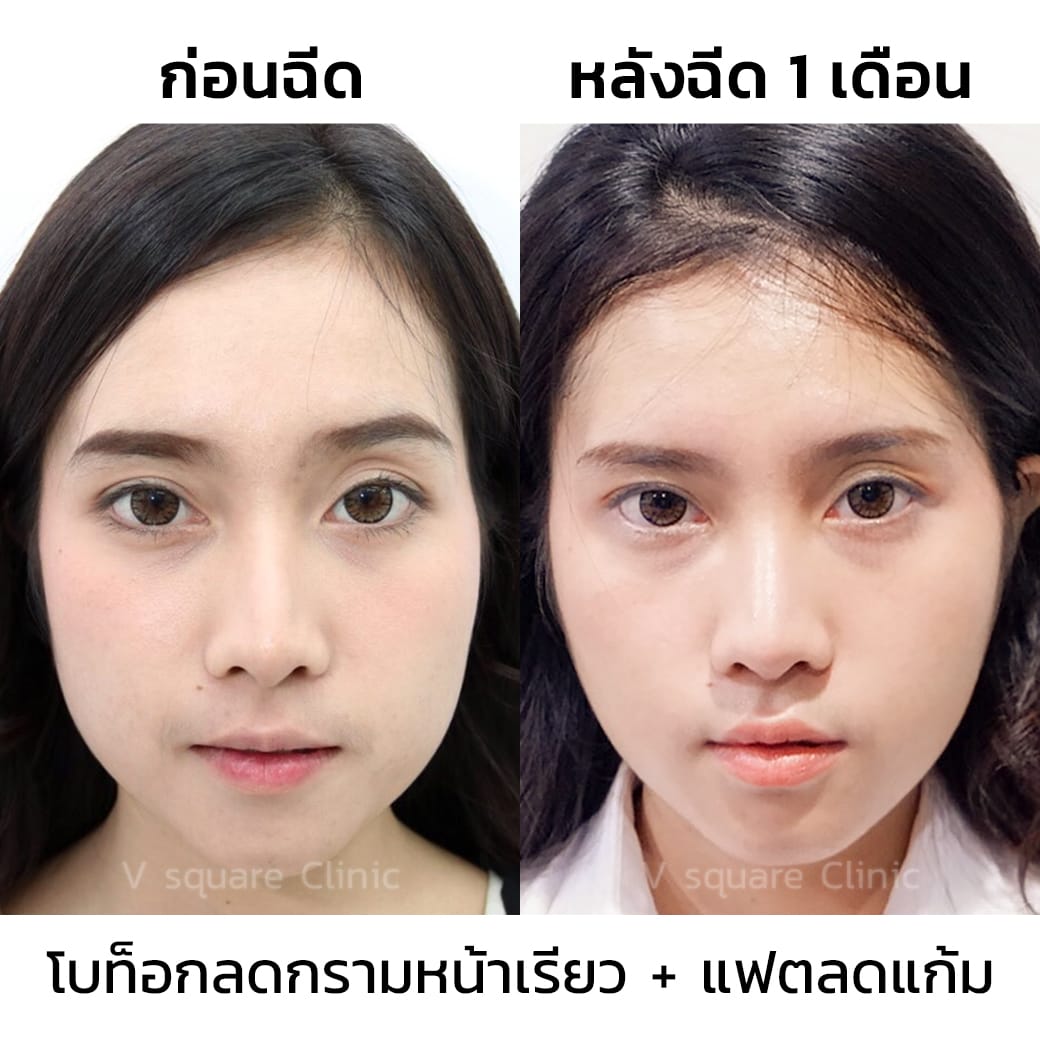 รีวิวโบท็อกลดกรามหน้าเรียว