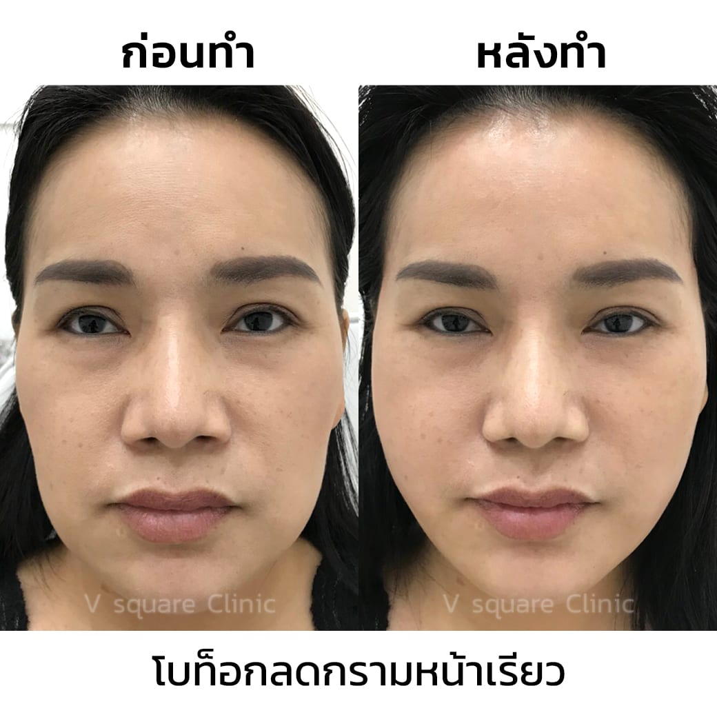 รีวิวโบท็อกลดกรามหน้าเรียว