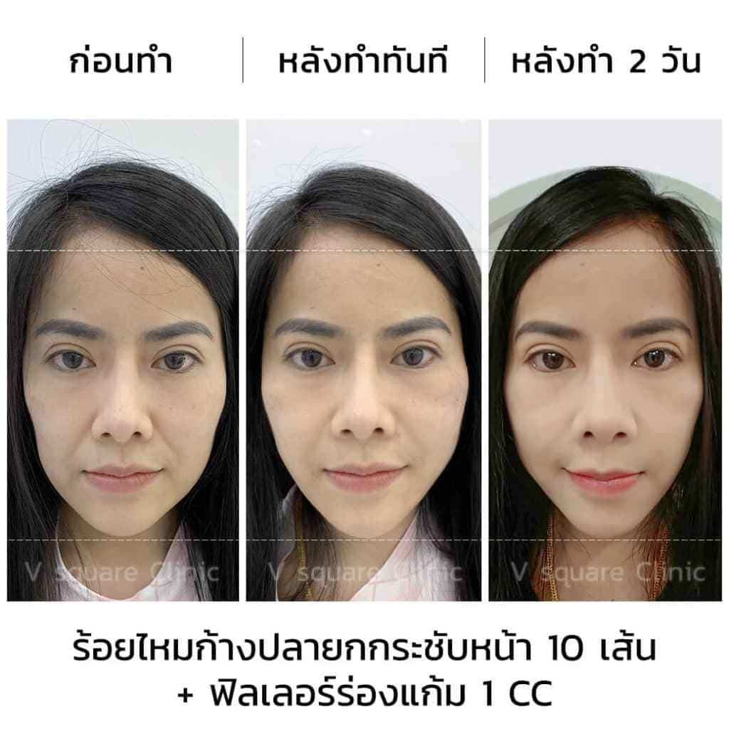 เส้นและเติมฟิลเลอร์ร่องแก้ม1cc เส้นและเติมฟิลเลอร์ร่องแก้ม1cc