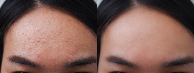 ฉีดเมโสหน้าใสอันตรายไหม ? มีข้อห้ามอะไรที่ควรรู้เพื่อไม่ให้เกิดผลข้างเคียง? ฉีดเมโสหน้าใสอันตรายไหม ? มีข้อห้ามอะไรที่ควรรู้เพื่อไม่ให้เกิดผลข้างเคียง?