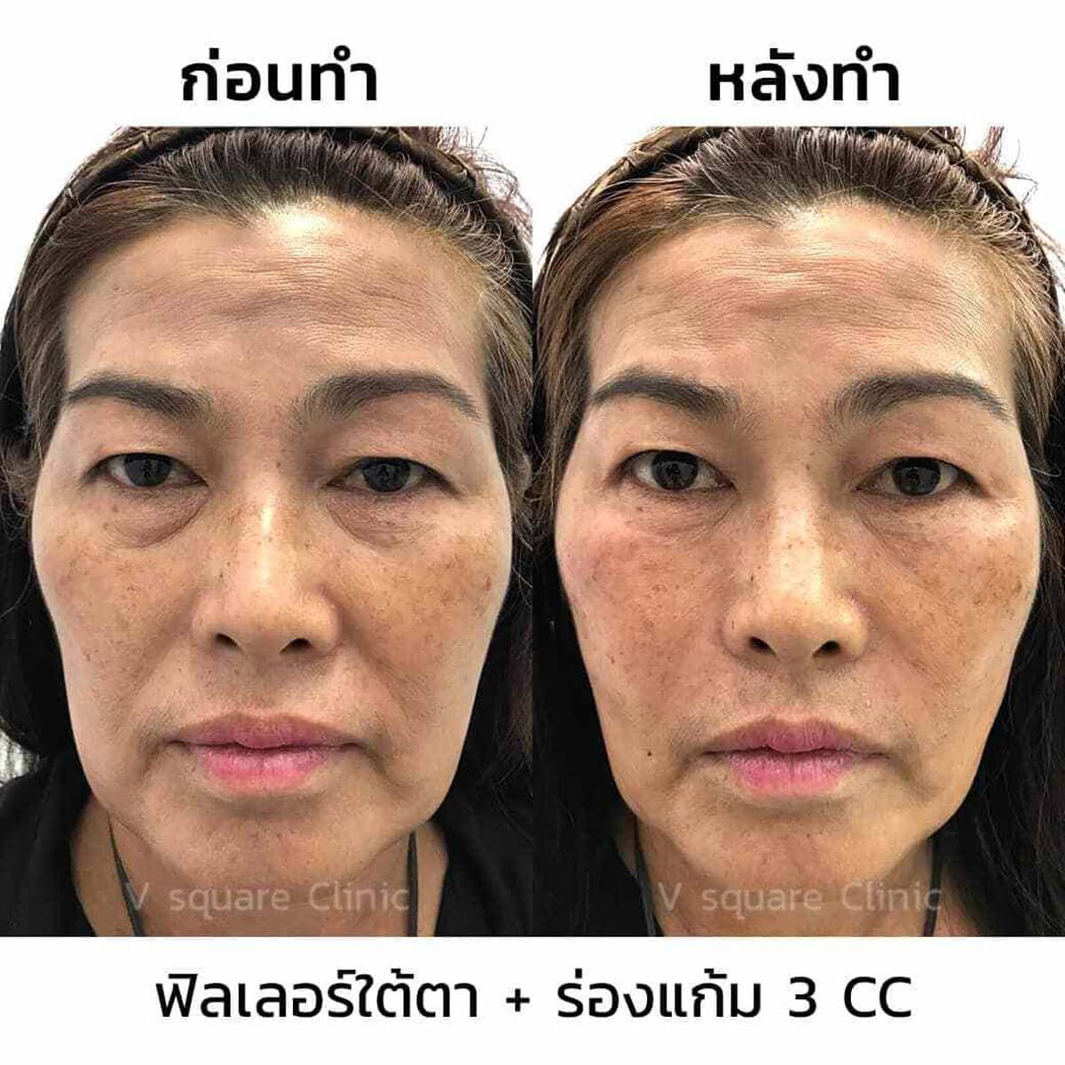 ฉีดฟิลเลอร์ใต้ตา ร่องแก้ม3CC