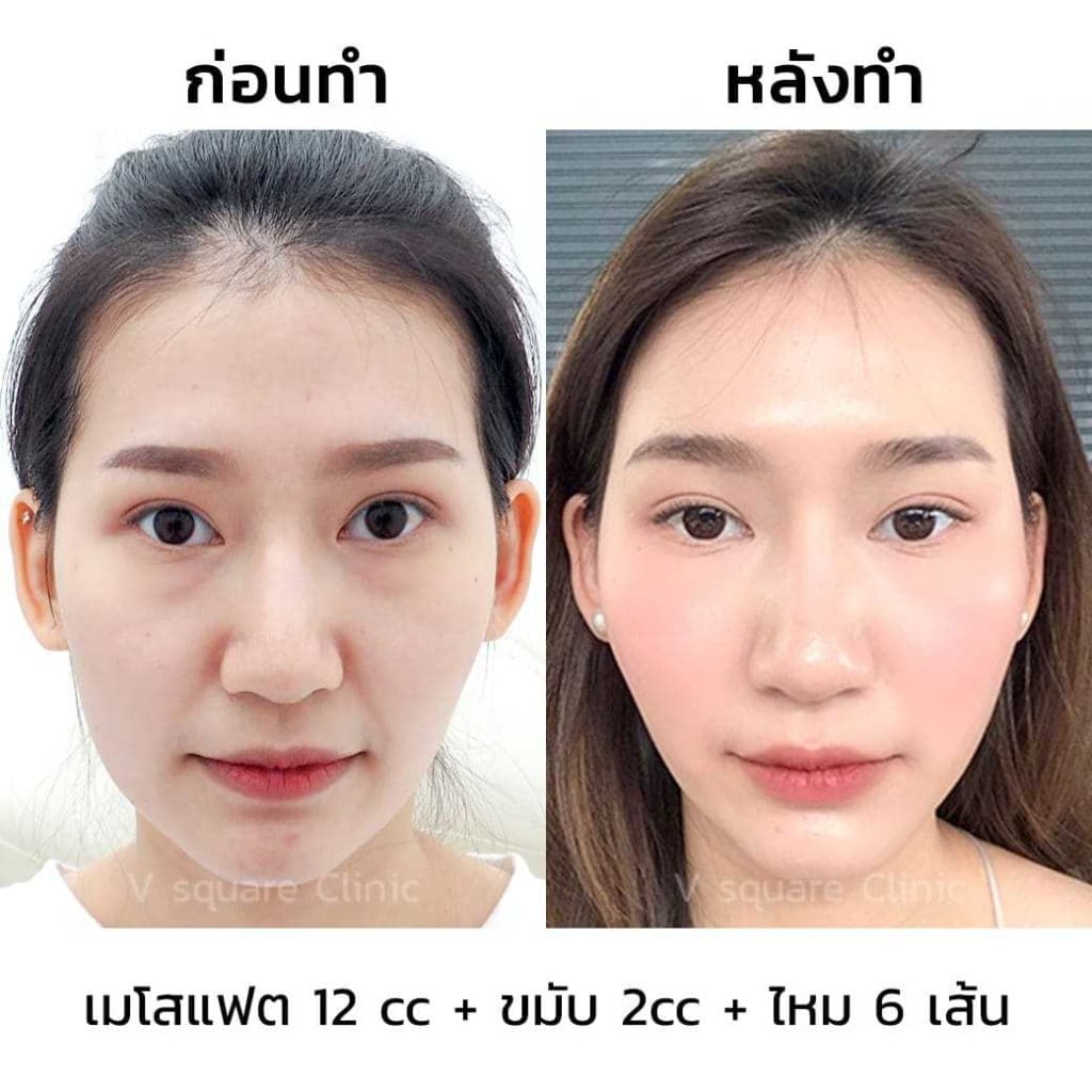 ตัวอย่างรีวิว ฉีดฟิลเลอร์ขมับ 2 cc