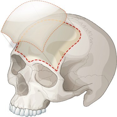 ทำไมการฉีดฟิลเลอร์หน้าผาก ราคาสูงกว่าจุดอื่น