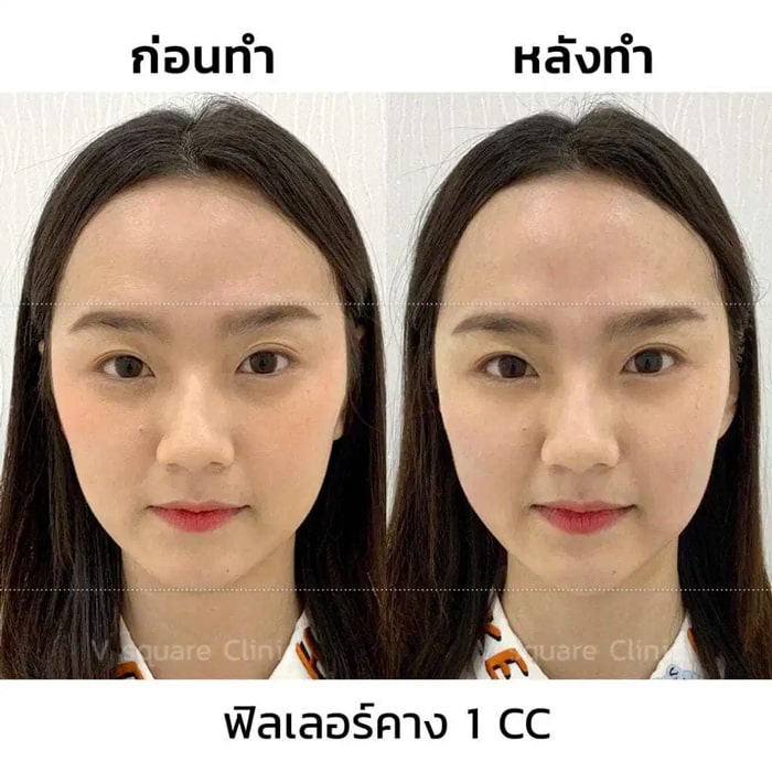 ฟิลเลอร์คาง1cc