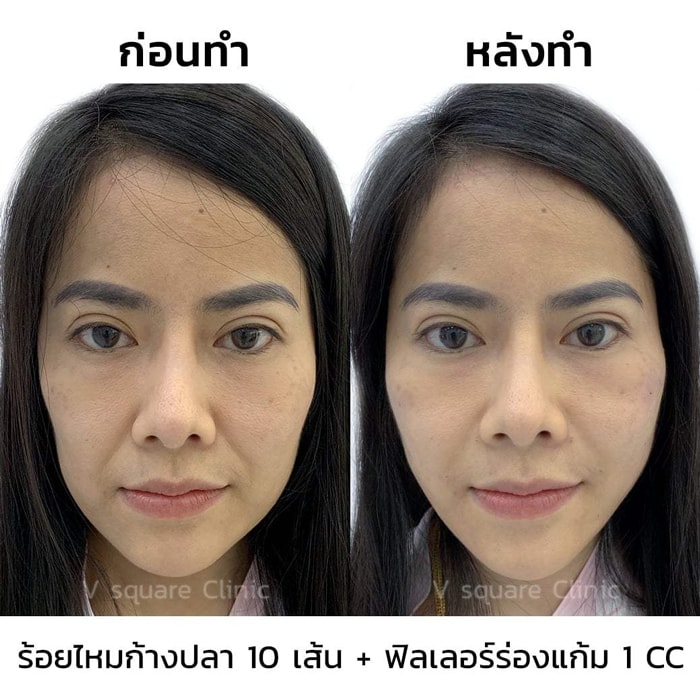 ฟิลเลอร์ร่องแก้ม1cc