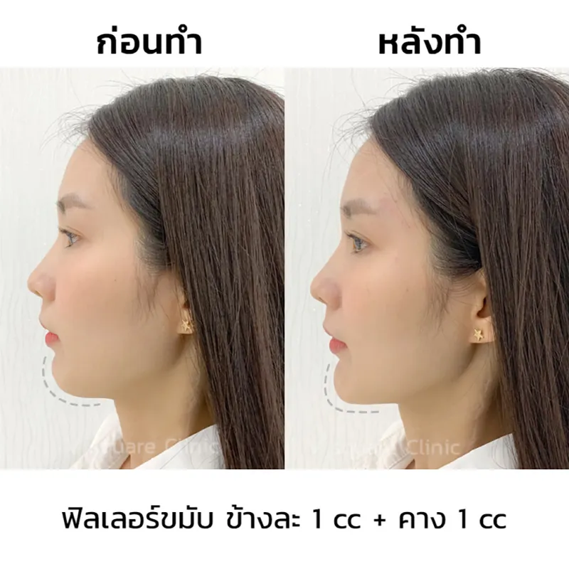 รีวิว ฉีดฟิลเลอร์คาง 1 CC.1