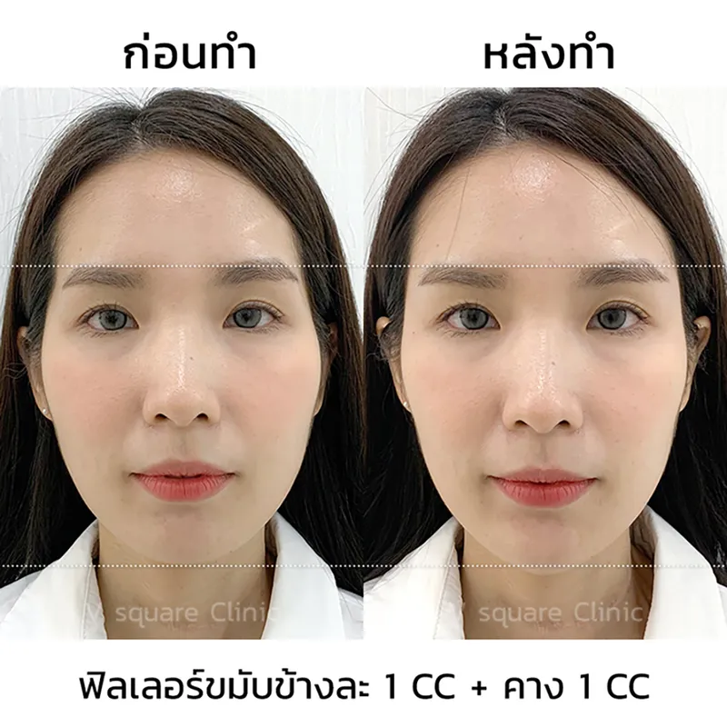 รีวิว ฉีดฟิลเลอร์คาง 1 CC