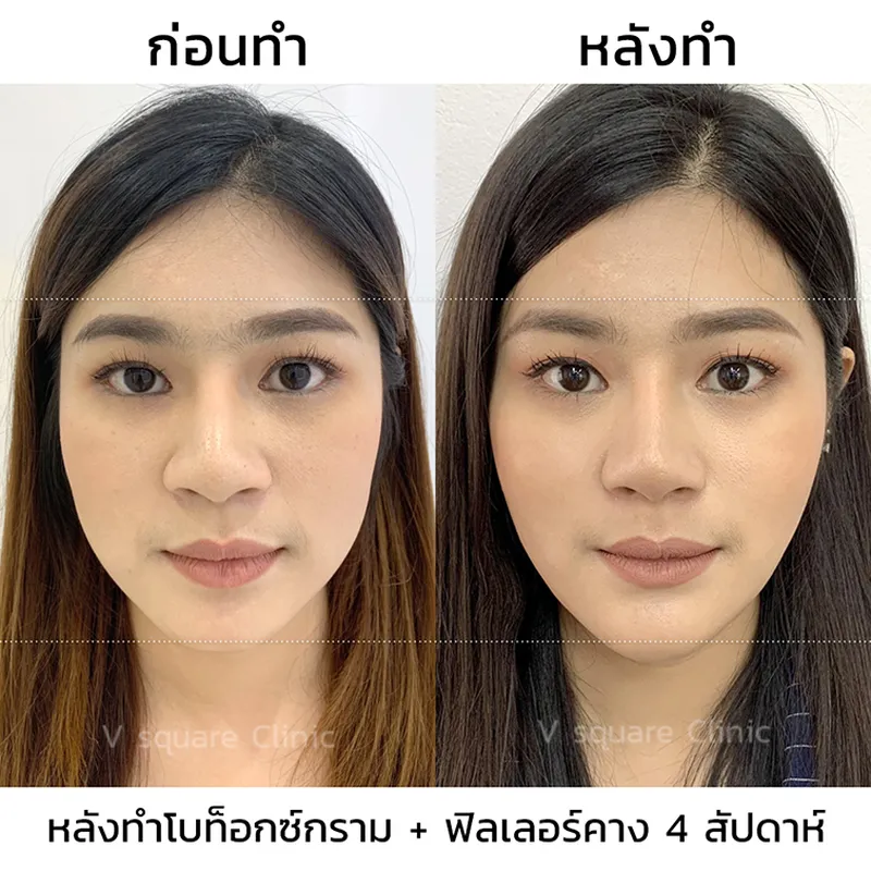 รีวิว ฉีดฟิลเลอร์คาง 4 สัปดาห์