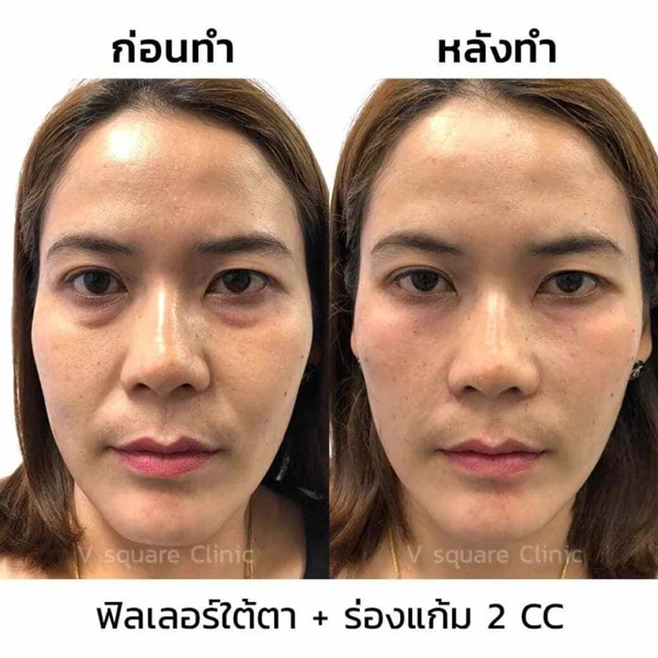 รีวิว ฟิลเลอร์ใต้ตา