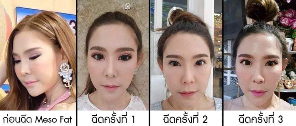 รีวิวฉีดเมโสแฟต