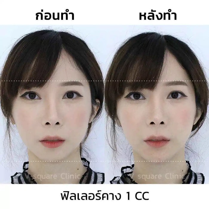 รีวิวฟิลเลอร์คาง