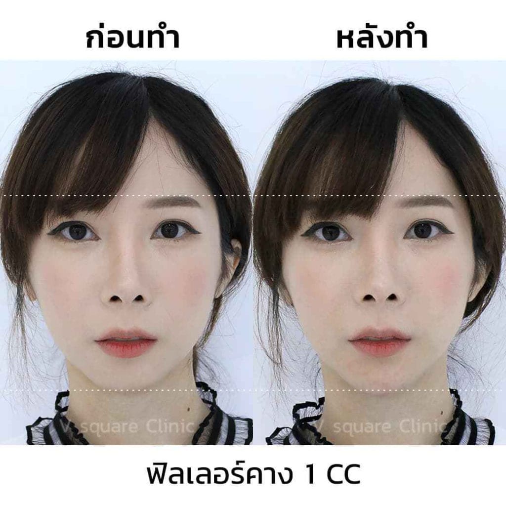 รีวิวฟิลเลอร์คาง 1CC