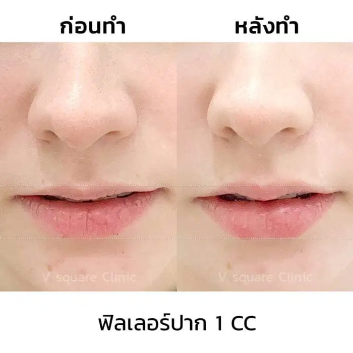 รีวิวฟิลเลอร์ปาก