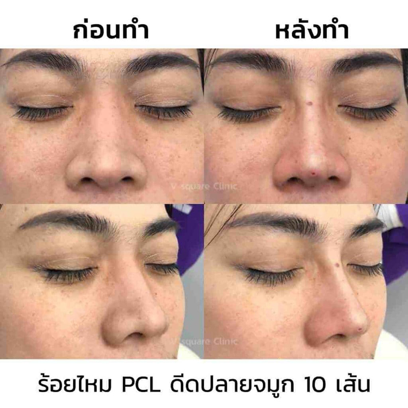 รีวิวร้อยไหม PCL ดีปลายจมูก 10 เส้น