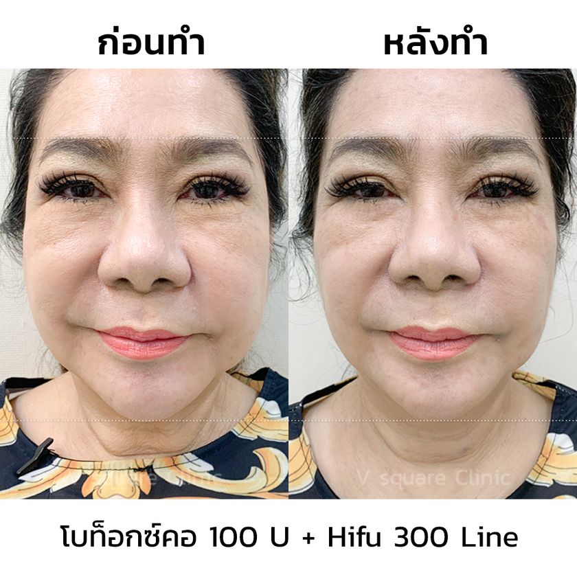 รีวิวโบท็อกลิฟหน้า