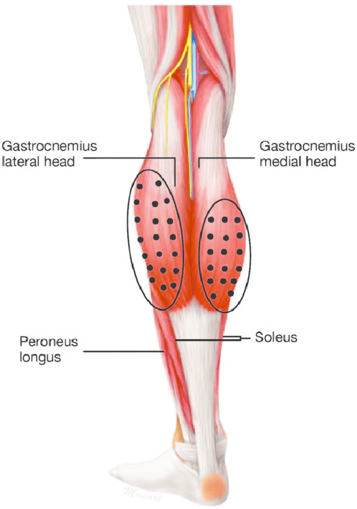 Gastrocnemius