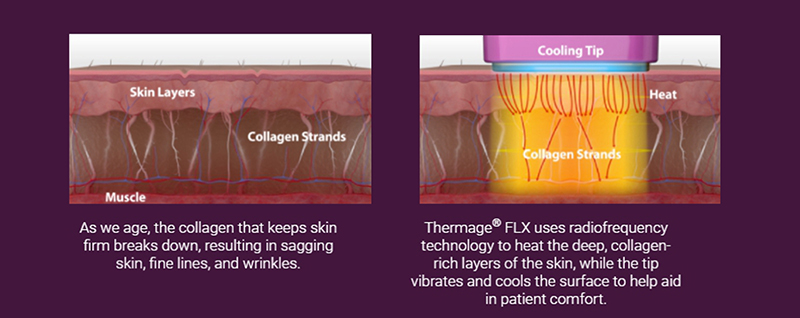 การทำงานของ Thermage ช่วยลดริ้วรอยผิวหย่อยคล้อย