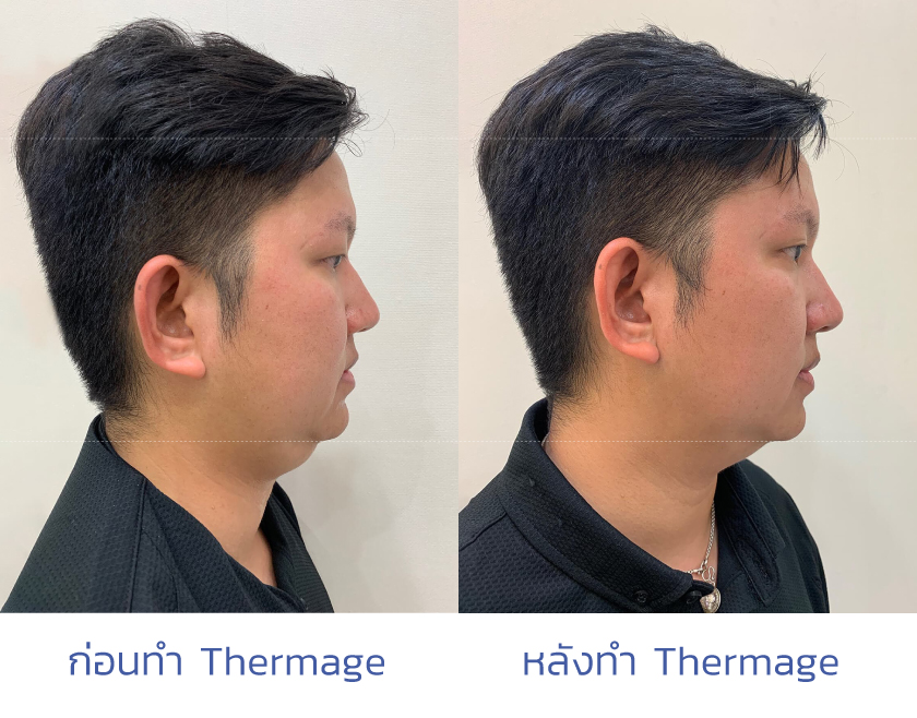 รีวิว Thermage ก่อนและหลังทำ