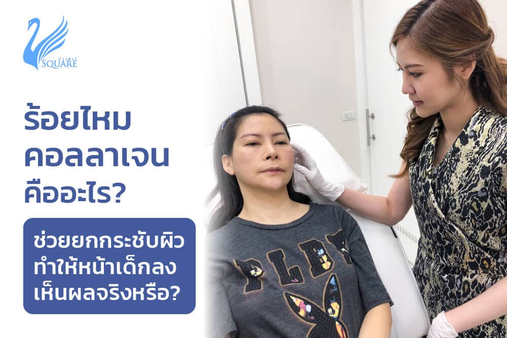 ร้อยไหมคอลลาเจน คืออะไร