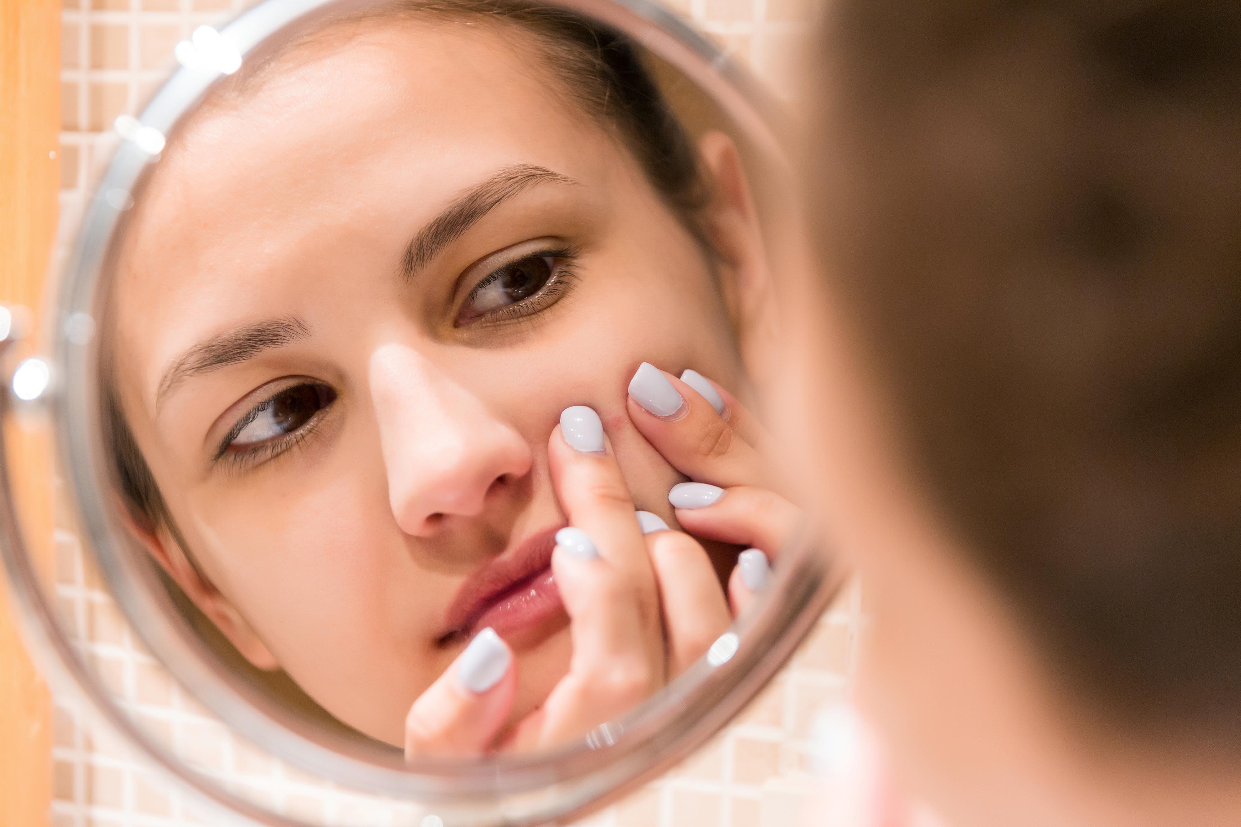 Young,Girl,Squeezes,Pimple,On,The,Fer,Face,In,Front