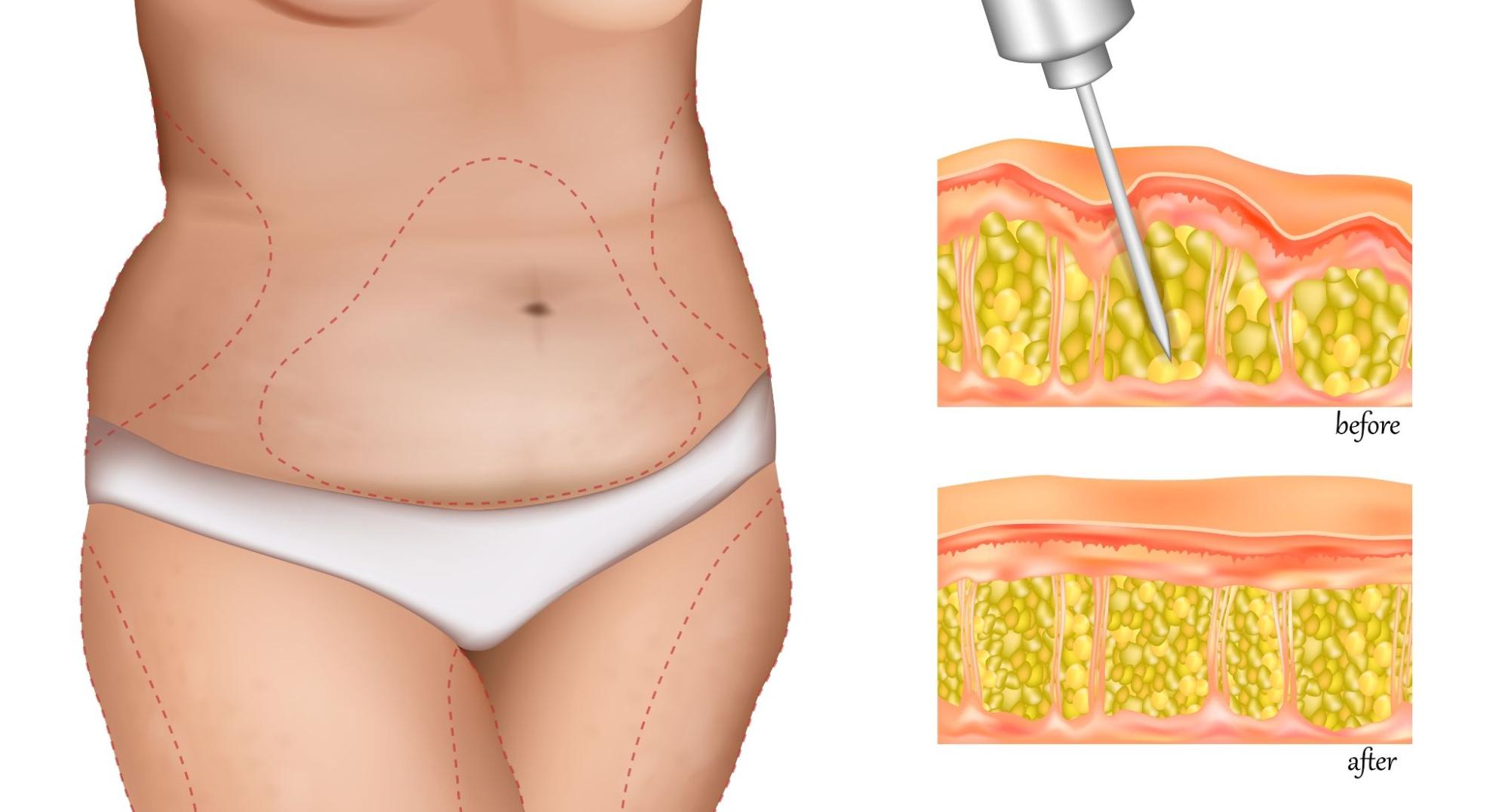 การดูดไขมัน (Liposuction)