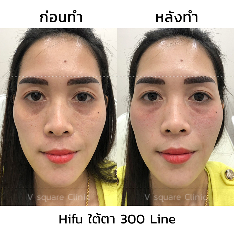 ฟิลเลอร์ใต้ตา-300-line