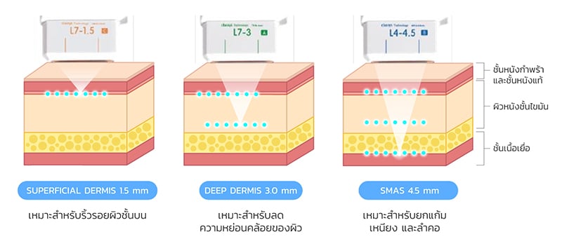 ระดับความลึกในการยิง ของหัว Ulthera SPT