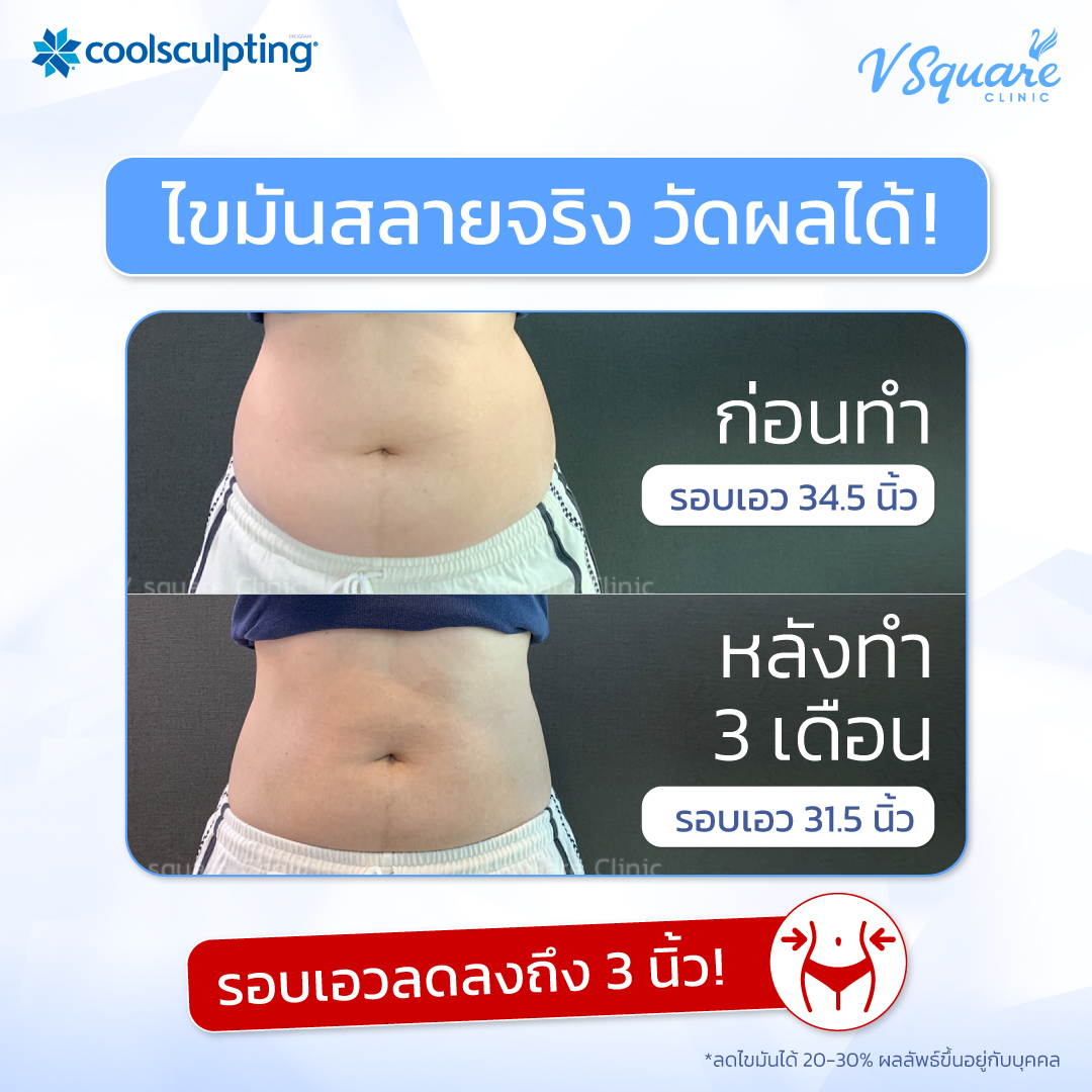 รีวิว CoolSculptingรีวิว CoolSculpting