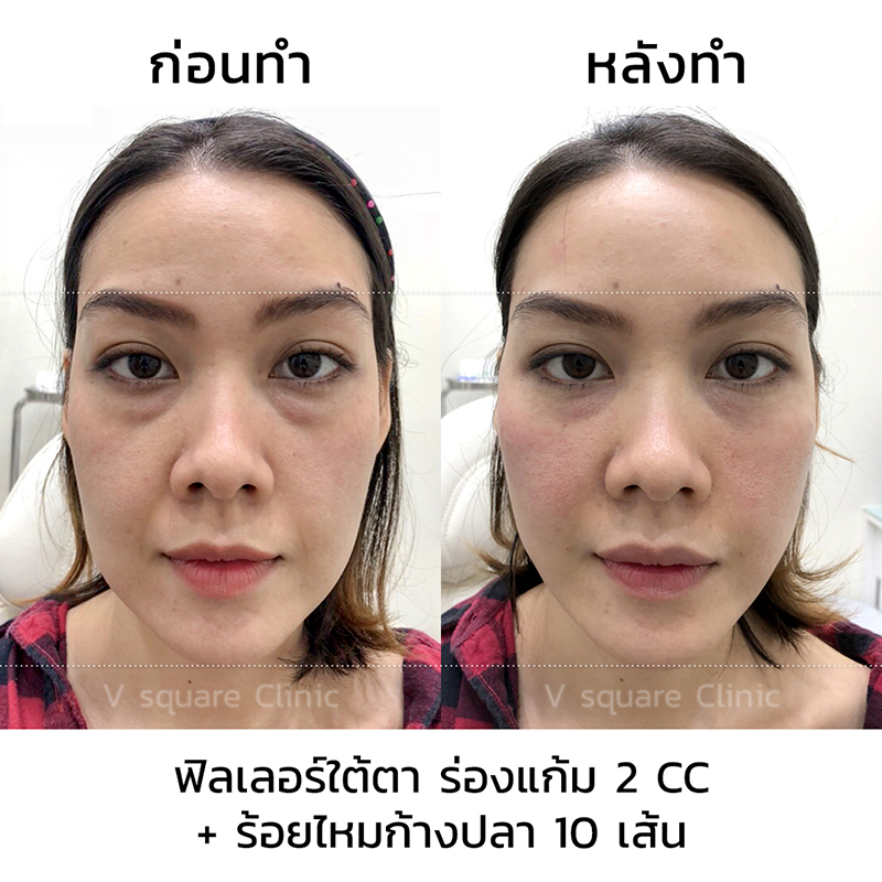 รีวิว ฉีดฟิลเลอร์ใต้ตา 2 CC ร้อยไหม 10 เส้น