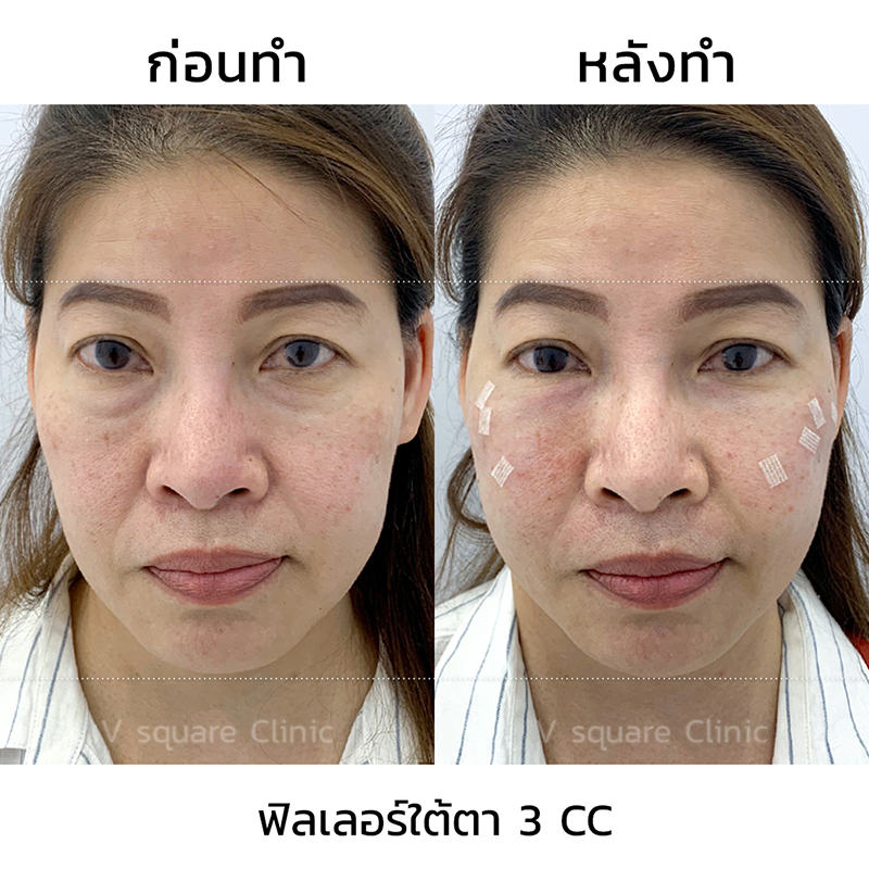 รีวิว ฉีดฟิลเลอร์ใต้ตา 3 CC