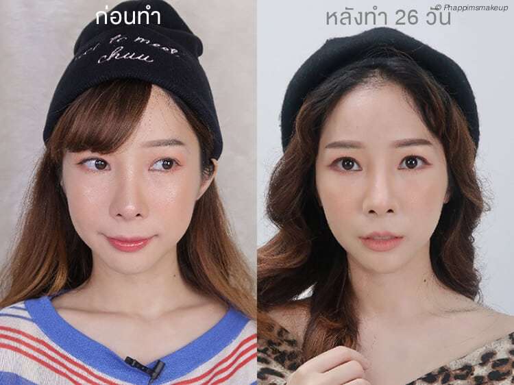 รีวิวultrahifuและหลังทำhifu