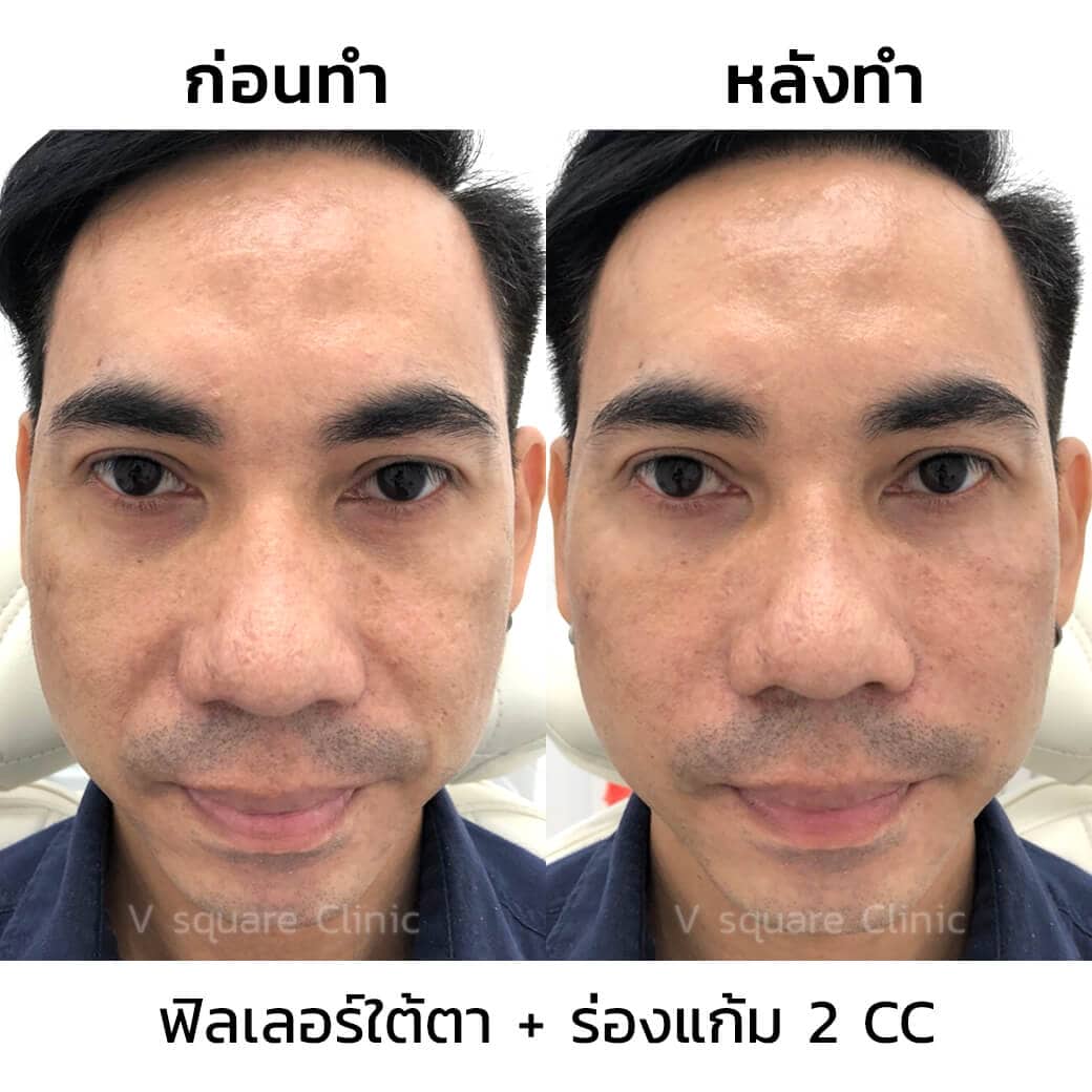 รีวิวฉีดฟิลเลอร์ร่องแก้ม2cc