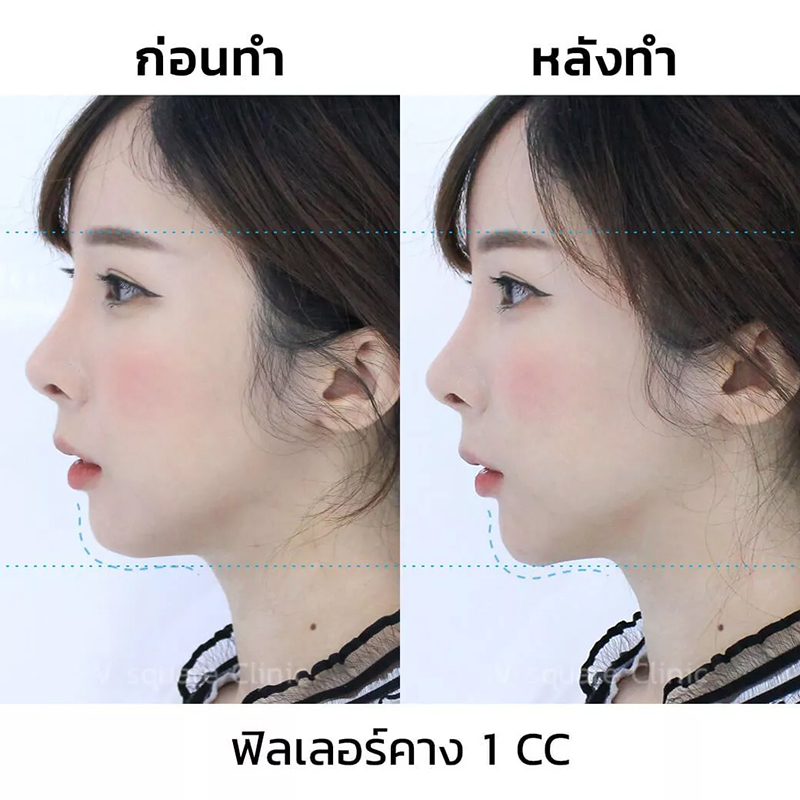 รีวิวฟิลเลอร์คาง-1-cc