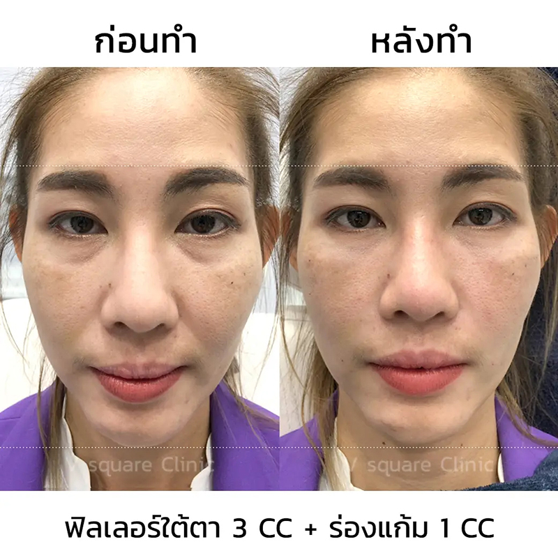 รีวิวฟิลเลอร์ใต้ตา-3-cc-และฟิลเลอร์ร่องแก้ม-1-cc