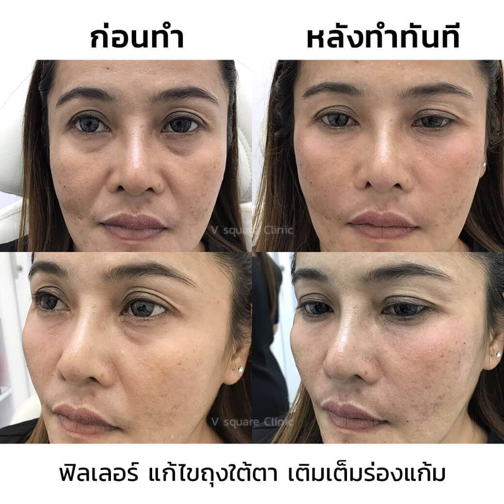 รีวิวเติมเต็มร่องแก้ม