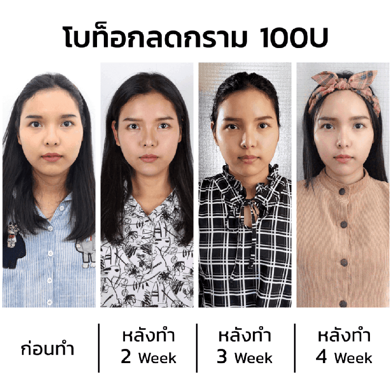 รีวิวโบท็อกลดกราม-และร้อยไหม-6-เส้น-แยกรายเดือน