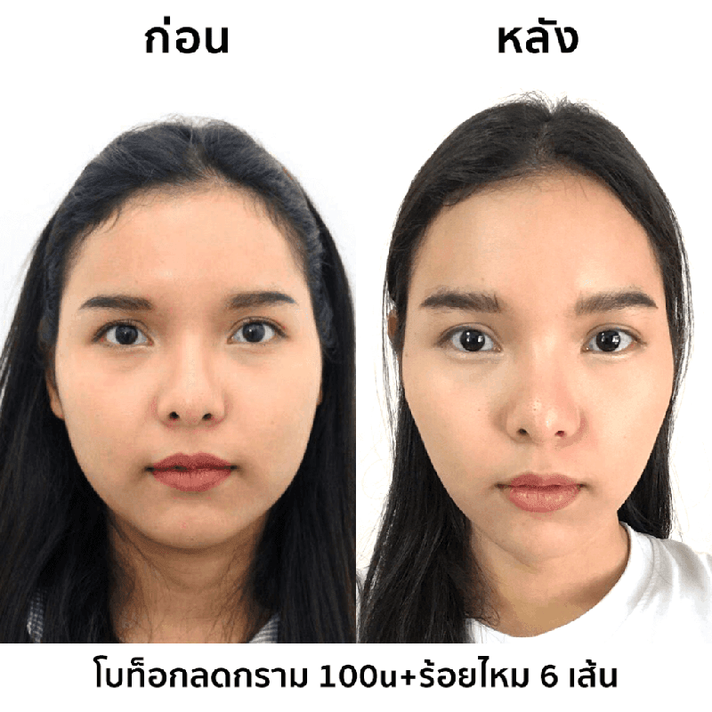 รีวิวโบท็อกลดกราม-และร้อยไหม-6-เส้น